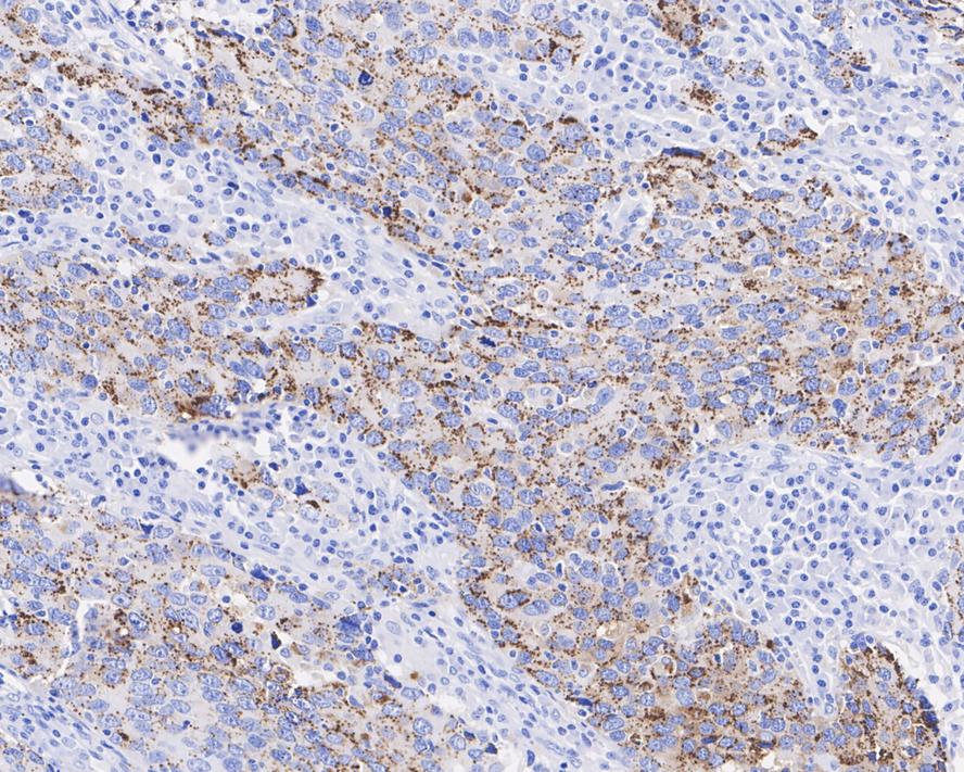Immunohistochemical analysis of paraffin-embedded human lung carcinoma tissue with Rabbit anti-Wnt5a antibody (ET1706-33) at 1/50 dilution.<br />
<br />
The section was pre-treated using heat mediated antigen retrieval with Tris-EDTA buffer (pH 8.0-8.4) for 20 minutes. The tissues were blocked in 1% BSA for 20 minutes at room temperature, washed with ddH2O and PBS, and then probed with the primary antibody (ET1706-33) at 1/50 dilution for 0.5 hour at room temperature. The detection was performed using an HRP conjugated compact polymer system. DAB was used as the chromogen. Tissues were counterstained with hematoxylin and mounted with DPX.
