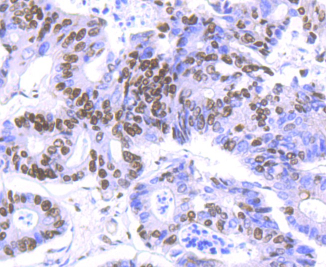 Immunohistochemical analysis of paraffin-embedded human colon carcinoma tissue using anti-HDAC9 antibody. The section was pre-treated using heat mediated antigen retrieval with Tris-EDTA buffer (pH 8.0-8.4) for 20 minutes.The tissues were blocked in 5% BSA for 30 minutes at room temperature, washed with ddH2O and PBS, and then probed with the primary antibody (ET1706-36, 1/50) for 30 minutes at room temperature. The detection was performed using an HRP conjugated compact polymer system. DAB was used as the chromogen. Tissues were counterstained with hematoxylin and mounted with DPX.