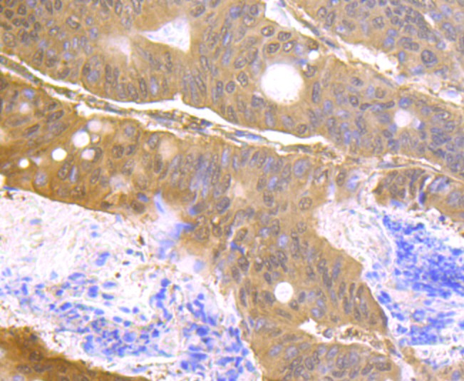 Immunohistochemical analysis of paraffin-embedded human colon carcinoma tissue with Rabbit anti-Usp14 antibody (ET1706-37) at 1/50 dilution.<br />
<br />
The section was pre-treated using heat mediated antigen retrieval with Tris-EDTA buffer (pH 9.0) for 20 minutes. The tissues were blocked in 1% BSA for 20 minutes at room temperature, washed with ddH2O and PBS, and then probed with the primary antibody (ET1706-37) at 1/50 dilution for 0.5 hour at room temperature. The detection was performed using an HRP conjugated compact polymer system. DAB was used as the chromogen. Tissues were counterstained with hematoxylin and mounted with DPX.