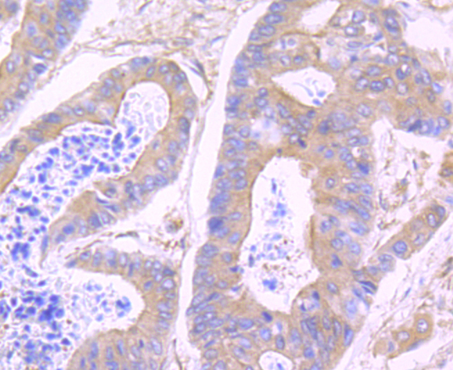 Immunohistochemical analysis of paraffin-embedded human colon cancer tissue using anti-WASL antibody. Counter stained with hematoxylin.