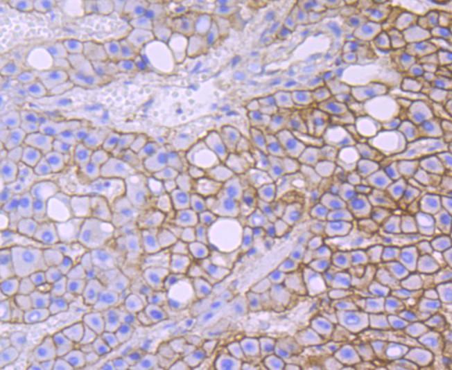 Immunohistochemical analysis of paraffin-embedded human liver carcinoma tissue using anti-Alpha Fodrin antibody. The section was pre-treated using heat mediated antigen retrieval with Tris-EDTA buffer (pH 9.0) for 20 minutes.The tissues were blocked in 1% BSA for 30 minutes at room temperature, washed with ddH2O and PBS, and then probed with the primary antibody (ET1706-44, 1/50) for 30 minutes at room temperature. The detection was performed using an HRP conjugated compact polymer system. DAB was used as the chromogen. Tissues were counterstained with hematoxylin and mounted with DPX.