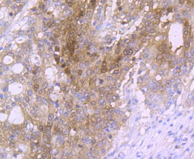 Immunohistochemical analysis of paraffin-embedded human stomach carcinoma tissue with Rabbit anti-Carbonic anhydrase 2 antibody (ET1706-47) at 1/50 dilution.<br />
<br />
The section was pre-treated using heat mediated antigen retrieval with Tris-EDTA buffer (pH 8.0-8.4) for 20 minutes. The tissues were blocked in 1% BSA for 20 minutes at room temperature, washed with ddH2O and PBS, and then probed with the primary antibody (ET1706-47) at 1/50 dilution for 0.5 hour at room temperature. The detection was performed using an HRP conjugated compact polymer system. DAB was used as the chromogen. Tissues were counterstained with hematoxylin and mounted with DPX.