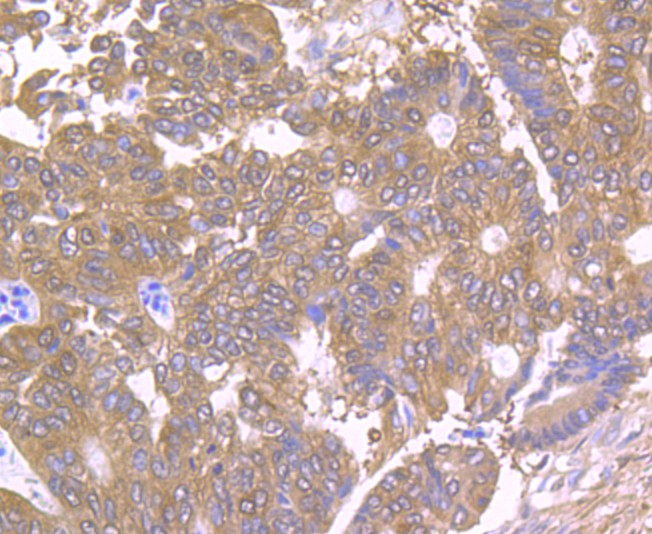 Immunohistochemical analysis of paraffin-embedded human colon carcinoma tissue with Rabbit anti-TCTP antibody (ET1706-48) at 1/50 dilution.<br />
<br />
The section was pre-treated using heat mediated antigen retrieval with Tris-EDTA buffer (pH 8.0-8.4) for 20 minutes. The tissues were blocked in 1% BSA for 20 minutes at room temperature, washed with ddH2O and PBS, and then probed with the primary antibody (ET1706-48) at 1/50 dilution for 0.5 hour at room temperature. The detection was performed using an HRP conjugated compact polymer system. DAB was used as the chromogen. Tissues were counterstained with hematoxylin and mounted with DPX.