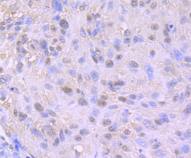 Immunohistochemical analysis of paraffin-embedded human lung carcinoma tissue with Rabbit anti-Nuclear Matrix Protein p84 antibody (ET1706-52) at 1/50 dilution.<br />
<br />
The section was pre-treated using heat mediated antigen retrieval with Tris-EDTA buffer (pH 9.0) for 20 minutes. The tissues were blocked in 1% BSA for 20 minutes at room temperature, washed with ddH2O and PBS, and then probed with the primary antibody (ET1706-52) at 1/50 dilution for 0.5 hour at room temperature. The detection was performed using an HRP conjugated compact polymer system. DAB was used as the chromogen. Tissues were counterstained with hematoxylin and mounted with DPX.