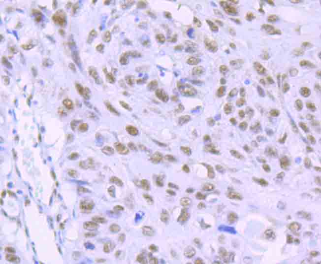 Immunohistochemical analysis of paraffin-embedded human lung carcinoma tissue with Rabbit anti-RbAP48 antibody (ET1706-54) at 1/100 dilution.<br />
<br />
The section was pre-treated using heat mediated antigen retrieval with sodium citrate buffer (pH 6.0) for 2 minutes. The tissues were blocked in 1% BSA for 20 minutes at room temperature, washed with ddH2O and PBS, and then probed with the primary antibody (ET1706-54) at 1/100 dilution for 1 hour at room temperature. The detection was performed using an HRP conjugated compact polymer system. DAB was used as the chromogen. Tissues were counterstained with hematoxylin and mounted with DPX.