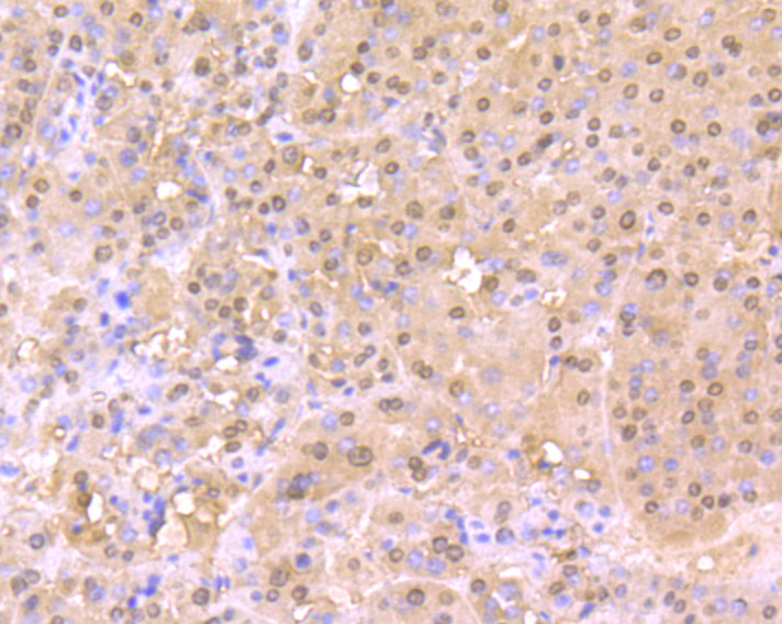 Immunohistochemical analysis of paraffin-embedded human liver carcinoma tissue using anti-Cullin 4a antibody. The section was pre-treated using heat mediated antigen retrieval with Tris-EDTA buffer (pH 8.0-8.4) for 20 minutes.The tissues were blocked in 5% BSA for 30 minutes at room temperature, washed with ddH2O and PBS, and then probed with the primary antibody (ET7106-56, 1/50) for 30 minutes at room temperature. The detection was performed using an HRP conjugated compact polymer system. DAB was used as the chromogen. Tissues were counterstained with hematoxylin and mounted with DPX.