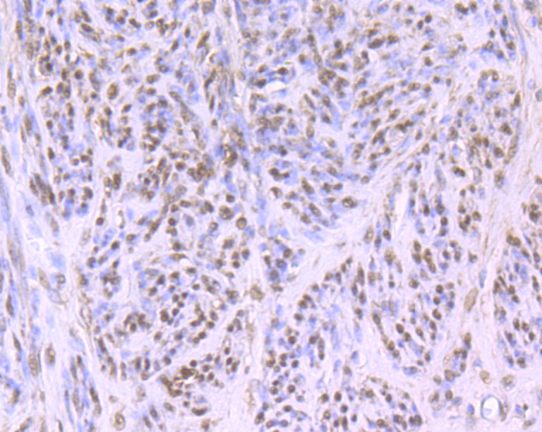 Immunohistochemical analysis of paraffin-embedded human cervix tissue using anti-Cullin 4a antibody. The section was pre-treated using heat mediated antigen retrieval with Tris-EDTA buffer (pH 8.0-8.4) for 20 minutes.The tissues were blocked in 5% BSA for 30 minutes at room temperature, washed with ddH2O and PBS, and then probed with the primary antibody (ET7106-56, 1/50) for 30 minutes at room temperature. The detection was performed using an HRP conjugated compact polymer system. DAB was used as the chromogen. Tissues were counterstained with hematoxylin and mounted with DPX.