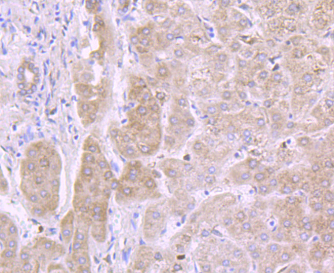 Immunohistochemical analysis of paraffin-embedded human liver tissue using anti-IL13 Receptor alpha 1 antibody. The section was pre-treated using heat mediated antigen retrieval with Tris-EDTA buffer (pH 8.0-8.4) for 20 minutes.The tissues were blocked in 5% BSA for 30 minutes at room temperature, washed with ddH2O and PBS, and then probed with the primary antibody (ET7106-61, 1/50) for 30 minutes at room temperature. The detection was performed using an HRP conjugated compact polymer system. DAB was used as the chromogen. Tissues were counterstained with hematoxylin and mounted with DPX.