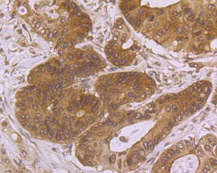 Immunohistochemical analysis of paraffin-embedded human colon carcinoma tissue using anti-villin1 antibody. The section was pre-treated using heat mediated antigen retrieval with Tris-EDTA buffer (pH 8.0-8.4) for 20 minutes.The tissues were blocked in 5% BSA for 30 minutes at room temperature, washed with ddH2O and PBS, and then probed with the primary antibody (ET7106-62, 1/50) for 30 minutes at room temperature. The detection was performed using an HRP conjugated compact polymer system. DAB was used as the chromogen. Tissues were counterstained with hematoxylin and mounted with DPX.