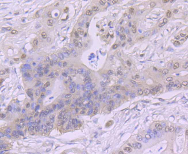 Immunohistochemical analysis of paraffin-embedded human colon cancer tissue using anti-CSNK2B antibody. Counter stained with hematoxylin.