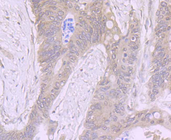 Immunohistochemical analysis of paraffin-embedded human colon carcinoma tissue using anti-ADAR antibody. The section was pre-treated using heat mediated antigen retrieval with Tris-EDTA buffer (pH 9.0) for 20 minutes.The tissues were blocked in 1% BSA for 30 minutes at room temperature, washed with ddH2O and PBS, and then probed with the primary antibody (ET7106-72, 1/50) for 30 minutes at room temperature. The detection was performed using an HRP conjugated compact polymer system. DAB was used as the chromogen. Tissues were counterstained with hematoxylin and mounted with DPX.