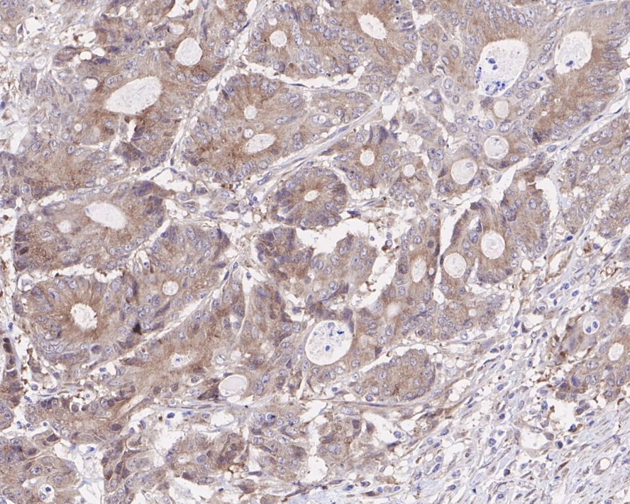 Immunohistochemical analysis of paraffin-embedded human colon carcinoma tissue with Rabbit anti-Cellular Apoptosis Susceptibility antibody (ET7106-90) at 1/200 dilution.<br />
<br />
The section was pre-treated using heat mediated antigen retrieval with sodium citrate buffer (pH 6.0) for 2 minutes. The tissues were blocked in 1% BSA for 20 minutes at room temperature, washed with ddH2O and PBS, and then probed with the primary antibody (ET7106-90) at 1/200 dilution for 1 hour at room temperature. The detection was performed using an HRP conjugated compact polymer system. DAB was used as the chromogen. Tissues were counterstained with hematoxylin and mounted with DPX.