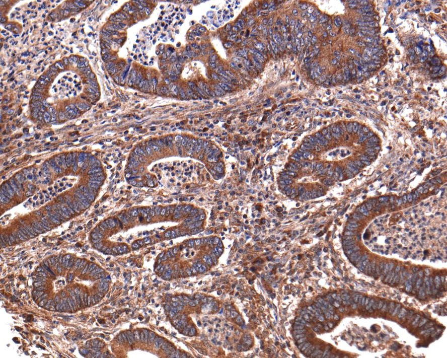 Immunohistochemical analysis of paraffin-embedded human colon carcinoma tissue with Rabbit anti-GIT1 antibody (ET7106-91) at 1/400 dilution.<br />
<br />
The section was pre-treated using heat mediated antigen retrieval with Tris-EDTA buffer (pH 9.0) for 20 minutes. The tissues were blocked in 1% BSA for 20 minutes at room temperature, washed with ddH2O and PBS, and then probed with the primary antibody (ET7106-91) at 1/400 dilution for 1 hour at room temperature. The detection was performed using an HRP conjugated compact polymer system. DAB was used as the chromogen. Tissues were counterstained with hematoxylin and mounted with DPX.