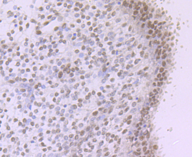 Immunohistochemical analysis of paraffin-embedded human colon carcinoma tissue using anti-NR1D1 antibody. The section was pre-treated using heat mediated antigen retrieval with Tris-EDTA buffer (pH 9.0) for 20 minutes.The tissues were blocked in 1% BSA for 30 minutes at room temperature, washed with ddH2O and PBS, and then probed with the primary antibody (ET7106-92, 1/50) for 30 minutes at room temperature. The detection was performed using an HRP conjugated compact polymer system. DAB was used as the chromogen. Tissues were counterstained with hematoxylin and mounted with DPX.