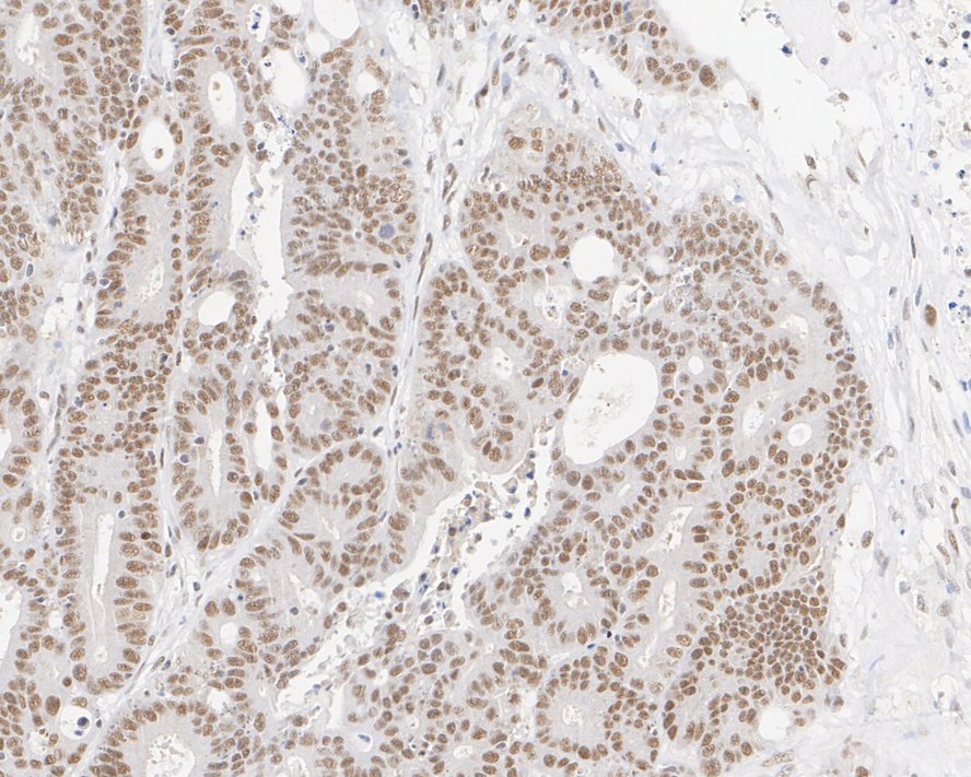 Immunohistochemical analysis of paraffin-embedded human colon cancer tissue with Rabbit anti-NR1D1 antibody (ET7106-92) at 1/200 dilution.<br />
<br />
The section was pre-treated using heat mediated antigen retrieval with sodium citrate buffer (pH 6.0) for 2 minutes. The tissues were blocked in 1% BSA for 20 minutes at room temperature, washed with ddH2O and PBS, and then probed with the primary antibody (ET7106-92) at 1/200 dilution for 1 hour at room temperature. The detection was performed using an HRP conjugated compact polymer system. DAB was used as the chromogen. Tissues were counterstained with hematoxylin and mounted with DPX.