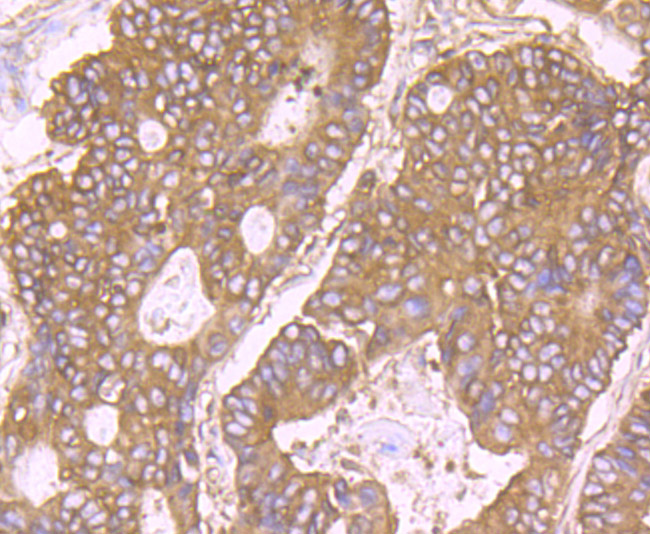 Immunohistochemical analysis of paraffin-embedded human colon cancer tissue using anti-RPS19 antibody. Counter stained with hematoxylin.