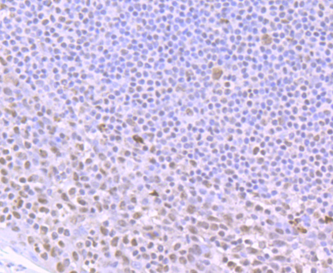 Immunohistochemical analysis of paraffin-embedded human tonsil tissue using anti-ILF2 antibody. The section was pre-treated using heat mediated antigen retrieval with Tris-EDTA buffer (pH 9.0) for 20 minutes.The tissues were blocked in 1% BSA for 30 minutes at room temperature, washed with ddH2O and PBS, and then probed with the primary antibody (ET7106-96, 1/50) for 30 minutes at room temperature. The detection was performed using an HRP conjugated compact polymer system. DAB was used as the chromogen. Tissues were counterstained with hematoxylin and mounted with DPX.