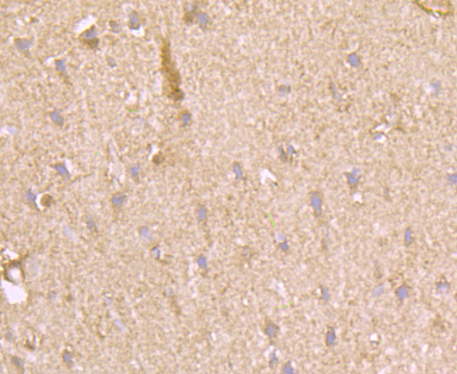 Immunohistochemical analysis of paraffin-embedded human liver carcinoma tissue using anti-Fructose 6 Phosphate Kinase antibody. The section was pre-treated using heat mediated antigen retrieval with Tris-EDTA buffer (pH 8.0-8.4) for 20 minutes.The tissues were blocked in 5% BSA for 30 minutes at room temperature, washed with ddH2O and PBS, and then probed with the primary antibody (ET7106-97, 1/50) for 30 minutes at room temperature. The detection was performed using an HRP conjugated compact polymer system. DAB was used as the chromogen. Tissues were counterstained with hematoxylin and mounted with DPX.