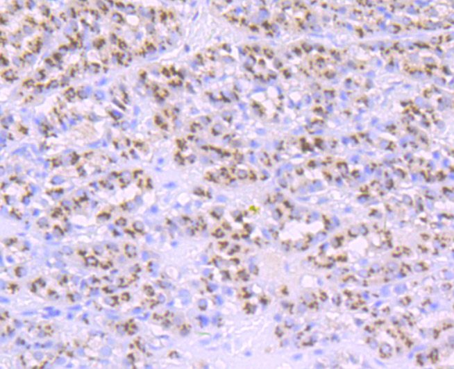 Immunohistochemical analysis of paraffin-embedded human liver carcinoma tissue using anti-PSME1 antibody. The section was pre-treated using heat mediated antigen retrieval with Tris-EDTA buffer (pH 9.0) for 20 minutes.The tissues were blocked in 1% BSA for 30 minutes at room temperature, washed with ddH2O and PBS, and then probed with the primary antibody (ET7106-98, 1/50) for 30 minutes at room temperature. The detection was performed using an HRP conjugated compact polymer system. DAB was used as the chromogen. Tissues were counterstained with hematoxylin and mounted with DPX.