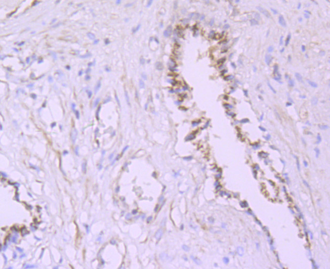 Immunohistochemical analysis of paraffin-embedded human prostate tissue using anti-PSME1 antibody. The section was pre-treated using heat mediated antigen retrieval with Tris-EDTA buffer (pH 9.0) for 20 minutes.The tissues were blocked in 1% BSA for 30 minutes at room temperature, washed with ddH2O and PBS, and then probed with the primary antibody (ET7106-98, 1/50) for 30 minutes at room temperature. The detection was performed using an HRP conjugated compact polymer system. DAB was used as the chromogen. Tissues were counterstained with hematoxylin and mounted with DPX.