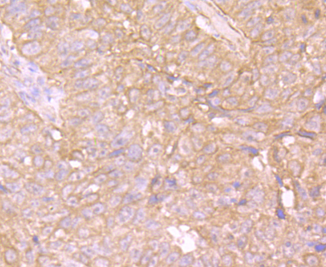 Immunohistochemical analysis of paraffin-embedded human lung cancer tissue using anti-EB3 antibody. Counter stained with hematoxylin.