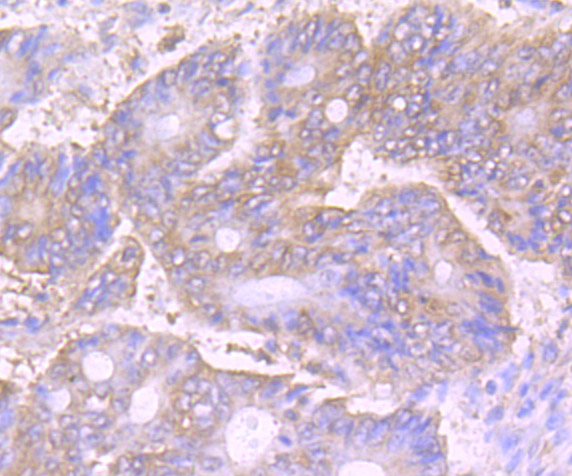 Immunohistochemical analysis of paraffin-embedded human colon cancer tissue using anti-VPS35 antibody. Counter stained with hematoxylin.