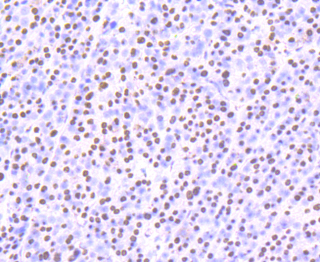 Immunohistochemical analysis of paraffin-embedded human liver cancer tissue using anti-SFPQ antibody. Counter stained with hematoxylin.