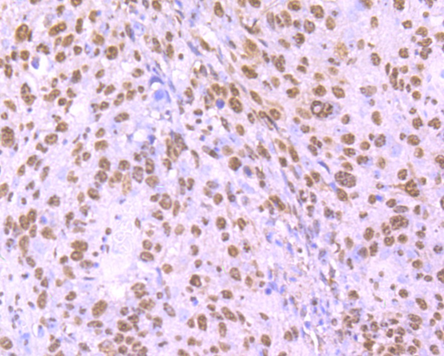 Immunohistochemical analysis of paraffin-embedded human lung carcinoma tissue using anti-hnRNP U antibody. The section was pre-treated using heat mediated antigen retrieval with Tris-EDTA buffer (pH 9.0) for 20 minutes.The tissues were blocked in 1% BSA for 30 minutes at room temperature, washed with ddH2O and PBS, and then probed with the primary antibody (ET7107-10, 1/50) for 30 minutes at room temperature. The detection was performed using an HRP conjugated compact polymer system. DAB was used as the chromogen. Tissues were counterstained with hematoxylin and mounted with DPX.