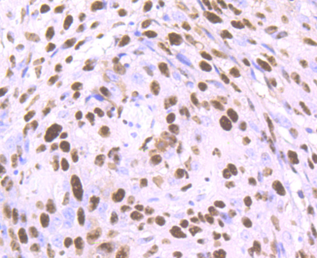 Immunohistochemical analysis of paraffin-embedded human lung carcinoma tissue using anti-SET antibody. The section was pre-treated using heat mediated antigen retrieval with Tris-EDTA buffer (pH 8.0-8.4) for 20 minutes.The tissues were blocked in 5% BSA for 30 minutes at room temperature, washed with ddH2O and PBS, and then probed with the primary antibody (ET7107-18, 1/50) for 30 minutes at room temperature. The detection was performed using an HRP conjugated compact polymer system. DAB was used as the chromogen. Tissues were counterstained with hematoxylin and mounted with DPX.