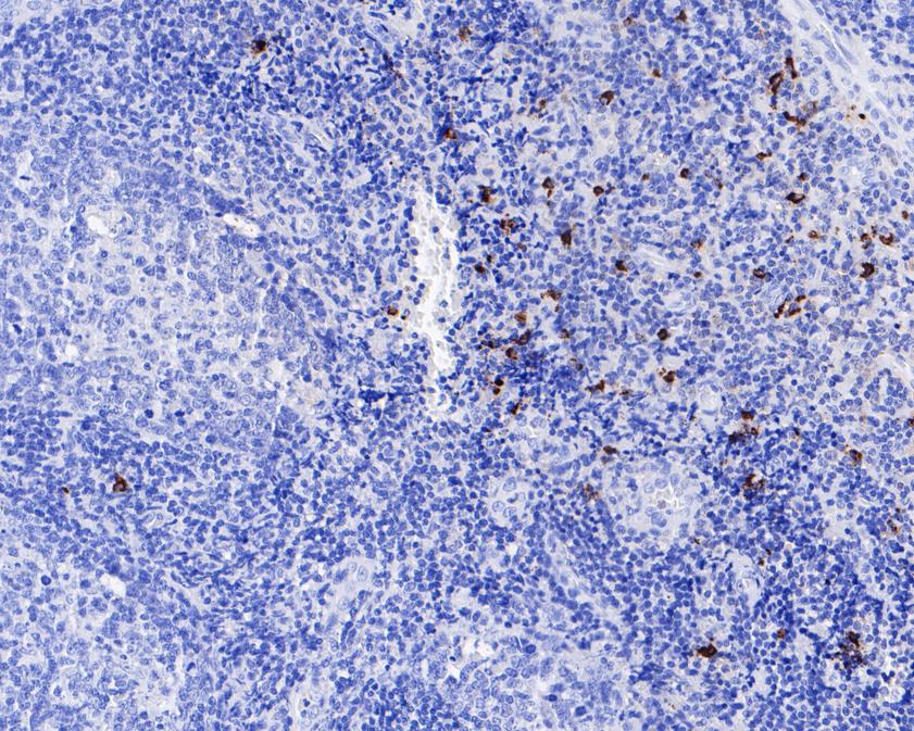 Immunohistochemical analysis of paraffin-embedded human tonsil tissue using anti-Mast Cell Chymase antibody. The section was pre-treated using heat mediated antigen retrieval with Tris-EDTA buffer (pH 8.0-8.4) for 20 minutes.The tissues were blocked in 5% BSA for 30 minutes at room temperature, washed with ddH2O and PBS, and then probed with the primary antibody (ET7107-19, 1/200) for 30 minutes at room temperature. The detection was performed using an HRP conjugated compact polymer system. DAB was used as the chromogen. Tissues were counterstained with hematoxylin and mounted with DPX.