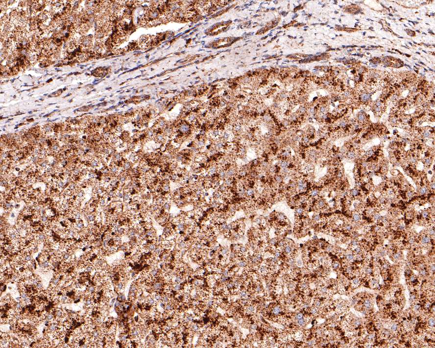 Immunohistochemical analysis of paraffin-embedded human liver tissue with Rabbit anti-Dcp1a antibody (ET7107-26) at 1/400 dilution.<br />
<br />
The section was pre-treated using heat mediated antigen retrieval with sodium citrate buffer (pH 6.0) for 2 minutes. The tissues were blocked in 1% BSA for 20 minutes at room temperature, washed with ddH2O and PBS, and then probed with the primary antibody (ET7107-26) at 1/400 dilution for 1 hour at room temperature. The detection was performed using an HRP conjugated compact polymer system. DAB was used as the chromogen. Tissues were counterstained with hematoxylin and mounted with DPX.