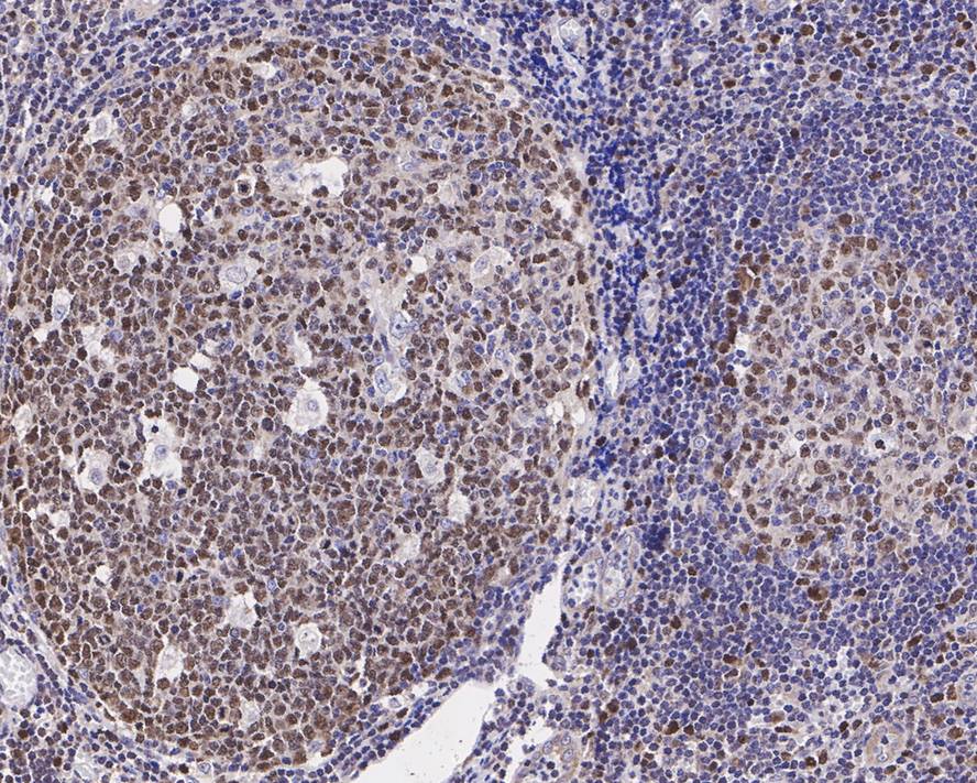 Immunohistochemical analysis of paraffin-embedded human tonsil tissue with Rabbit anti-Nesprin 1 antibody (ET7107-28) at 1/200 dilution.<br />
<br />
The section was pre-treated using heat mediated antigen retrieval with sodium citrate buffer (pH 6.0) for 2 minutes. The tissues were blocked in 1% BSA for 20 minutes at room temperature, washed with ddH2O and PBS, and then probed with the primary antibody (ET7107-28) at 1/200 dilution for 1 hour at room temperature. The detection was performed using an HRP conjugated compact polymer system. DAB was used as the chromogen. Tissues were counterstained with hematoxylin and mounted with DPX.