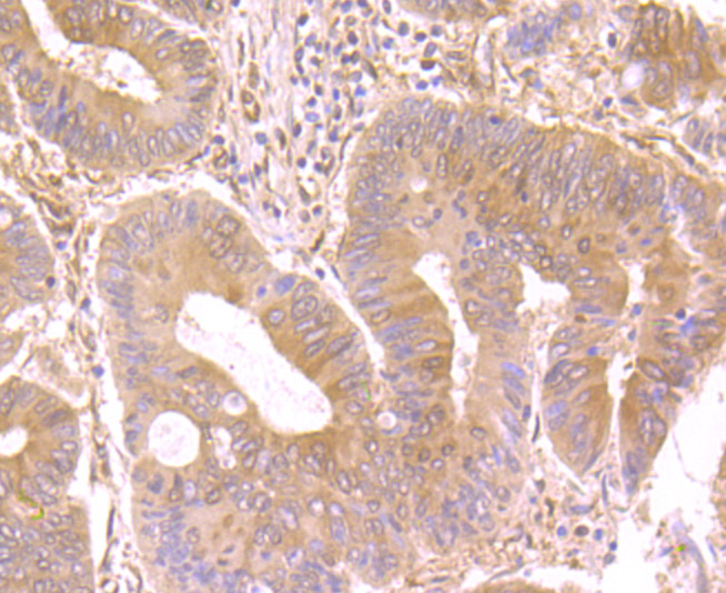 Immunohistochemical analysis of paraffin-embedded human colon cancer tissue using anti-Nesprin 1 antibody. Counter stained with hematoxylin.