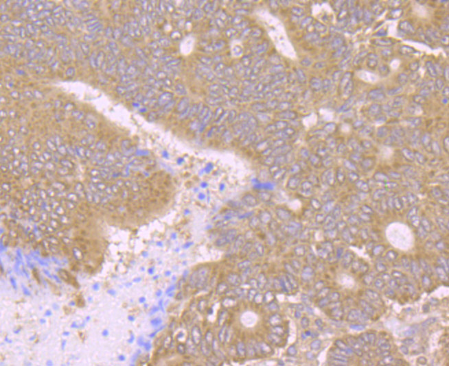 Immunohistochemical analysis of paraffin-embedded human colon cancer tissue using anti-PCK2 antibody. Counter stained with hematoxylin.