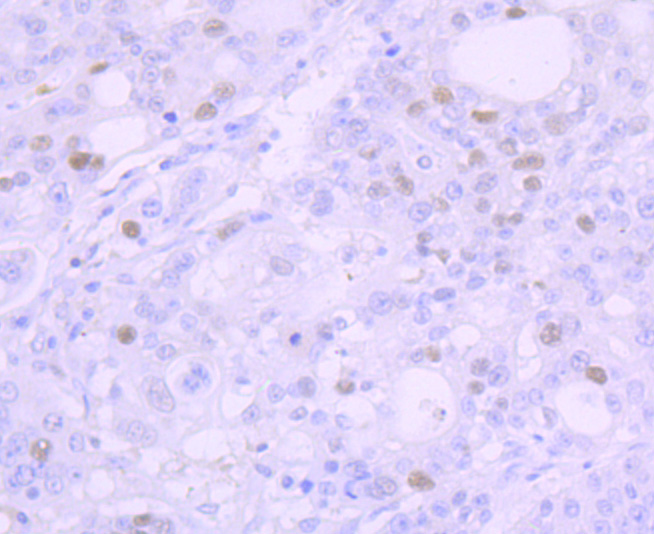 Immunohistochemical analysis of paraffin-embedded human stomach carcinoma tissue using anti-Mutant p53 antibody. The section was pre-treated using heat mediated antigen retrieval with Tris-EDTA buffer (pH 8.0-8.4) for 20 minutes.The tissues were blocked in 5% BSA for 30 minutes at room temperature, washed with ddH2O and PBS, and then probed with the primary antibody (ET7107-33, 1/50) for 30 minutes at room temperature. The detection was performed using an HRP conjugated compact polymer system. DAB was used as the chromogen. Tissues were counterstained with hematoxylin and mounted with DPX.