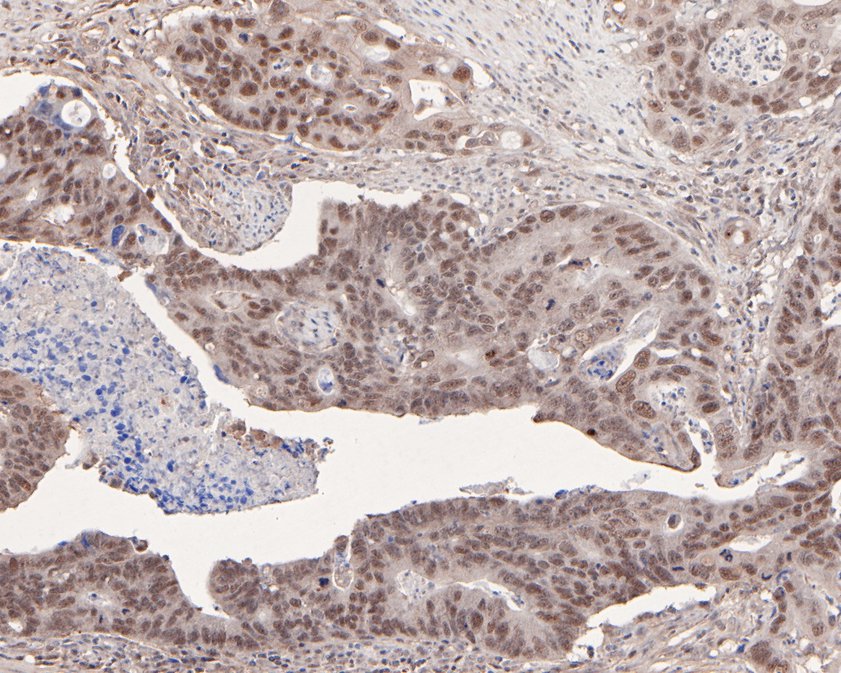 Immunohistochemical analysis of paraffin-embedded human colon carcinoma tissue using anti-Mutant p53 antibody. The section was pre-treated using heat mediated antigen retrieval with sodium citrate buffer (pH 6.0) for 20 minutes. The tissues were blocked in 5% BSA for 30 minutes at room temperature, washed with ddH2O and PBS, and then probed with the primary antibody (ET7107-33, 1/50)  for 30 minutes at room temperature. The detection was performed using an HRP conjugated compact polymer system. DAB was used as the chromogen. Tissues were counterstained with hematoxylin and mounted with DPX.
