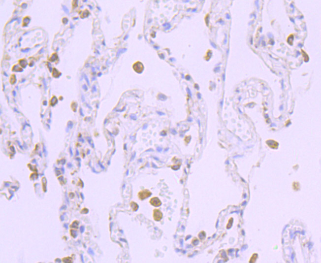 Immunohistochemical analysis of paraffin-embedded human lung carcinoma tissue using anti-Cytochrome P450 Reductase antibody. The section was pre-treated using heat mediated antigen retrieval with Tris-EDTA buffer (pH 8.0-8.4) for 20 minutes.The tissues were blocked in 5% BSA for 30 minutes at room temperature, washed with ddH2O and PBS, and then probed with the primary antibody (ET7107-35, 1/50) for 30 minutes at room temperature. The detection was performed using an HRP conjugated compact polymer system. DAB was used as the chromogen. Tissues were counterstained with hematoxylin and mounted with DPX.