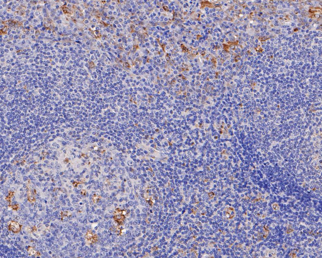 Immunohistochemical analysis of paraffin-embedded human liver tissue using anti-TGF alpha antibody. Counter stained with hematoxylin.