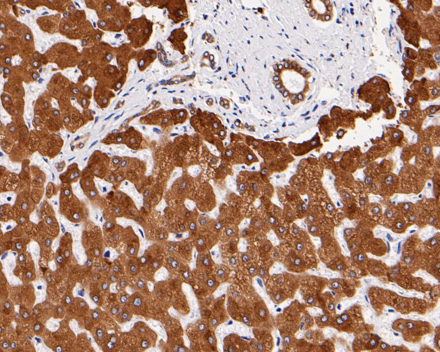 Immunohistochemical analysis of paraffin-embedded human colon cancer tissue using anti-TGF alpha antibody. Counter stained with hematoxylin.