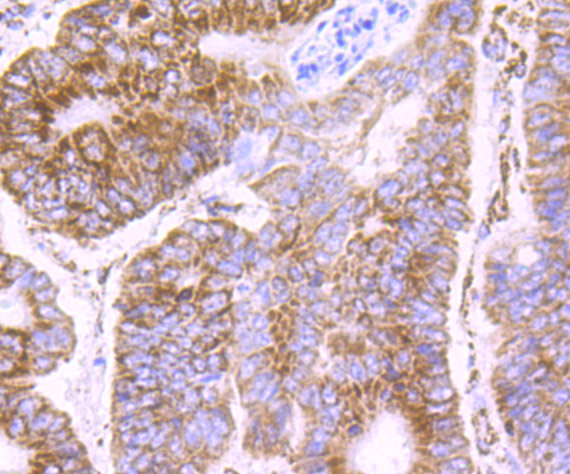 Immunohistochemical analysis of paraffin-embedded human colon carcinoma tissue using anti-PDK2 antibody. The section was pre-treated using heat mediated antigen retrieval with Tris-EDTA buffer (pH 8.0-8.4) for 20 minutes.The tissues were blocked in 5% BSA for 30 minutes at room temperature, washed with ddH2O and PBS, and then probed with the primary antibody (ET7107-46, 1/50) for 30 minutes at room temperature. The detection was performed using an HRP conjugated compact polymer system. DAB was used as the chromogen. Tissues were counterstained with hematoxylin and mounted with DPX.