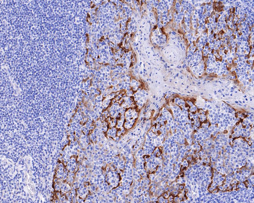 Immunohistochemical analysis of paraffin-embedded human tonsil tissue with Rabbit anti-Galectin 7 antibody (ET7107-54) at 1/400 dilution.<br />
<br />
The section was pre-treated using heat mediated antigen retrieval with sodium citrate buffer (pH 6.0) for 2 minutes. The tissues were blocked in 1% BSA for 20 minutes at room temperature, washed with ddH2O and PBS, and then probed with the primary antibody (ET7107-54) at 1/400 dilution for 1 hour at room temperature. The detection was performed using an HRP conjugated compact polymer system. DAB was used as the chromogen. Tissues were counterstained with hematoxylin and mounted with DPX.