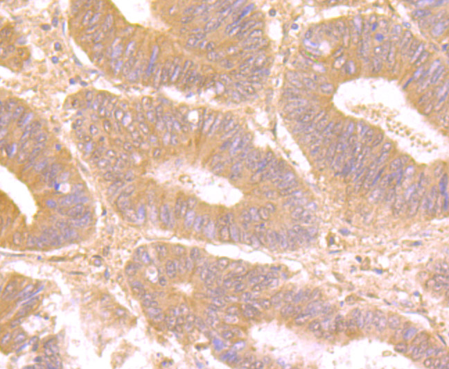 Immunohistochemical analysis of paraffin-embedded human colon carcinoma tissue using anti-Galectin 8 antibody. The section was pre-treated using heat mediated antigen retrieval with Tris-EDTA buffer (pH 8.0-8.4) for 20 minutes.The tissues were blocked in 5% BSA for 30 minutes at room temperature, washed with ddH2O and PBS, and then probed with the primary antibody (ET7107-56, 1/50) for 30 minutes at room temperature. The detection was performed using an HRP conjugated compact polymer system. DAB was used as the chromogen. Tissues were counterstained with hematoxylin and mounted with DPX.
