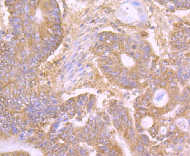 Immunohistochemical analysis of paraffin-embedded human colon carcinoma tissue using anti-LY75 antibody. The section was pre-treated using heat mediated antigen retrieval with Tris-EDTA buffer (pH 9.0) for 20 minutes.The tissues were blocked in 1% BSA for 30 minutes at room temperature, washed with ddH2O and PBS, and then probed with the primary antibody (ET7107-58, 1/50) for 30 minutes at room temperature. The detection was performed using an HRP conjugated compact polymer system. DAB was used as the chromogen. Tissues were counterstained with hematoxylin and mounted with DPX.