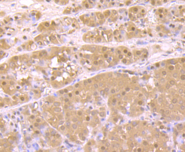 Immunohistochemical analysis of paraffin-embedded human liver cancer tissue using anti-Proteasome 20S C2 antibody. Counter stained with hematoxylin.