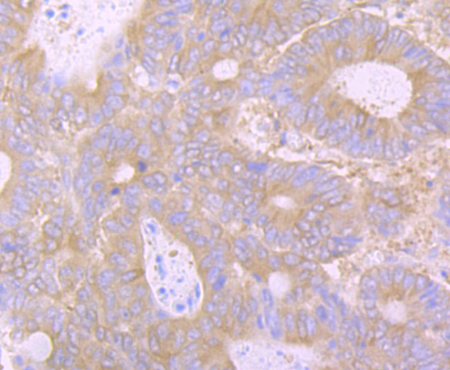 Immunohistochemical analysis of paraffin-embedded human colon carcinoma tissue using anti-Huntingtin antibody. The section was pre-treated using heat mediated antigen retrieval with Tris-EDTA buffer (pH 9.0) for 20 minutes.The tissues were blocked in 1% BSA for 30 minutes at room temperature, washed with ddH2O and PBS, and then probed with the primary antibody (ET7107-60, 1/50) for 30 minutes at room temperature. The detection was performed using an HRP conjugated compact polymer system. DAB was used as the chromogen. Tissues were counterstained with hematoxylin and mounted with DPX.
