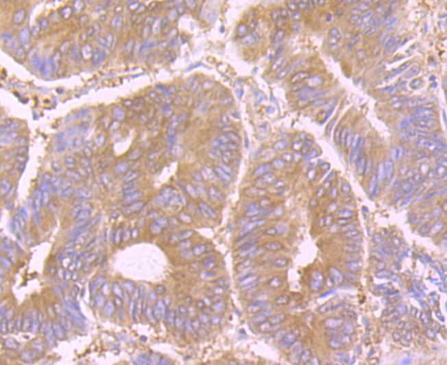 Immunohistochemical analysis of paraffin-embedded human colon cancer tissue using anti-STIP1 antibody. Counter stained with hematoxylin.