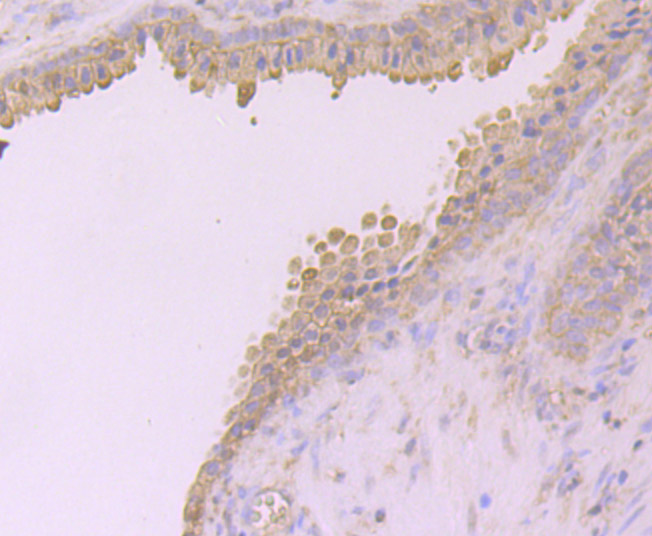 Immunohistochemical analysis of paraffin-embedded human colon cancer tissue using anti-Desmoglein 2 antibody. Counter stained with hematoxylin.