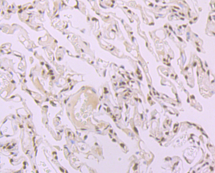 Immunohistochemical analysis of paraffin-embedded human lung carcinoma tissue using anti-SF2 antibody. The section was pre-treated using heat mediated antigen retrieval with Tris-EDTA buffer (pH 9.0) for 20 minutes.The tissues were blocked in 1% BSA for 30 minutes at room temperature, washed with ddH2O and PBS, and then probed with the primary antibody (ET7107-70, 1/50) for 30 minutes at room temperature. The detection was performed using an HRP conjugated compact polymer system. DAB was used as the chromogen. Tissues were counterstained with hematoxylin and mounted with DPX.