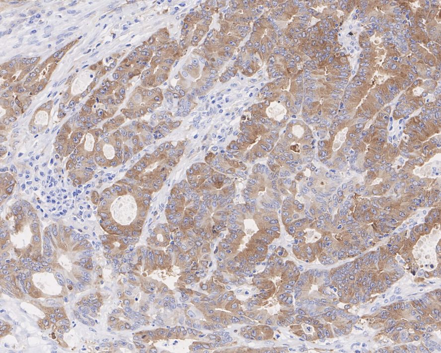 Immunohistochemical analysis of paraffin-embedded human colon tissue using anti-RRM1 antibody. The section was pre-treated using heat mediated antigen retrieval with Tris-EDTA buffer (pH 9.0) for 20 minutes.The tissues were blocked in 1% BSA for 30 minutes at room temperature, washed with ddH2O and PBS, and then probed with the primary antibody (ET7107-72, 1/50) for 30 minutes at room temperature. The detection was performed using an HRP conjugated compact polymer system. DAB was used as the chromogen. Tissues were counterstained with hematoxylin and mounted with DPX.