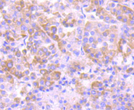 Immunohistochemical analysis of paraffin-embedded human liver carcinoma tissue using anti-eEF1A1 antibody. The section was pre-treated using heat mediated antigen retrieval with Tris-EDTA buffer (pH 8.0-8.4) for 20 minutes.The tissues were blocked in 5% BSA for 30 minutes at room temperature, washed with ddH2O and PBS, and then probed with the primary antibody (ET7107-75, 1/50) for 30 minutes at room temperature. The detection was performed using an HRP conjugated compact polymer system. DAB was used as the chromogen. Tissues were counterstained with hematoxylin and mounted with DPX.